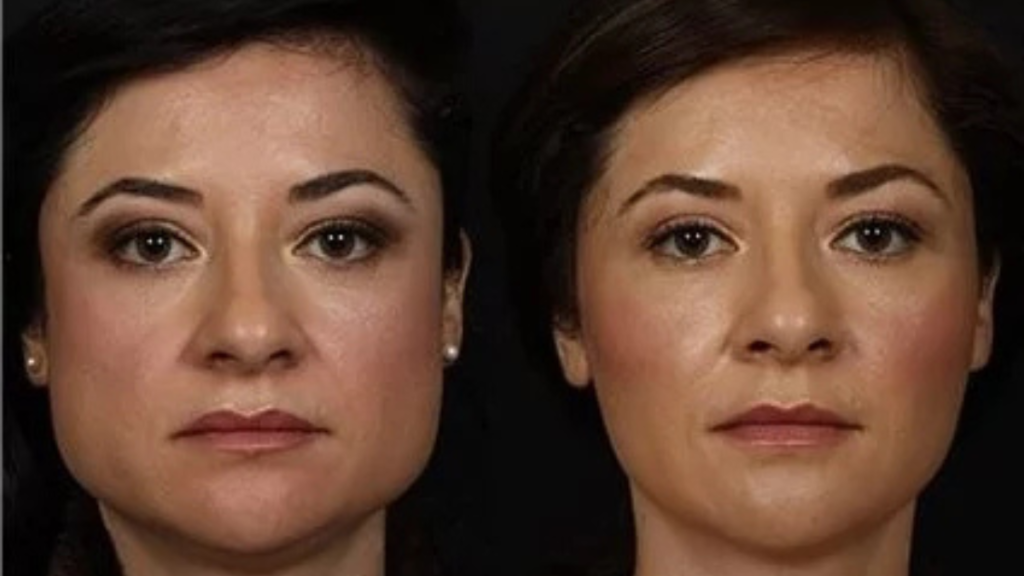 masseter botox vorher nachher