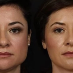 masseter botox vorher nachher